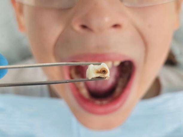 Best Cracked Tooth Emergency Dentist  in Versailles, MO